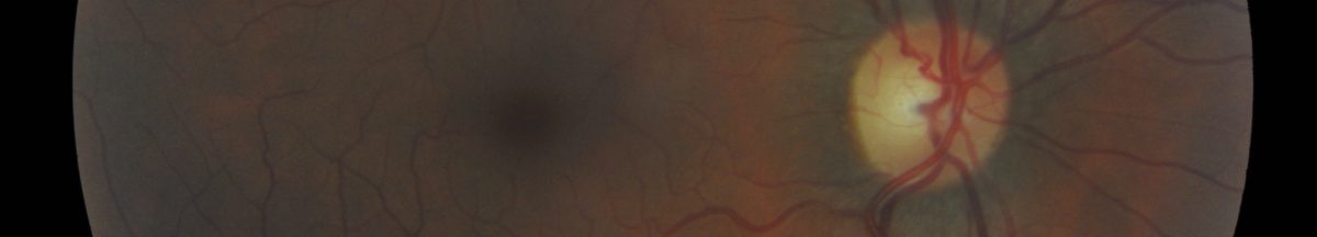 Retinal photo